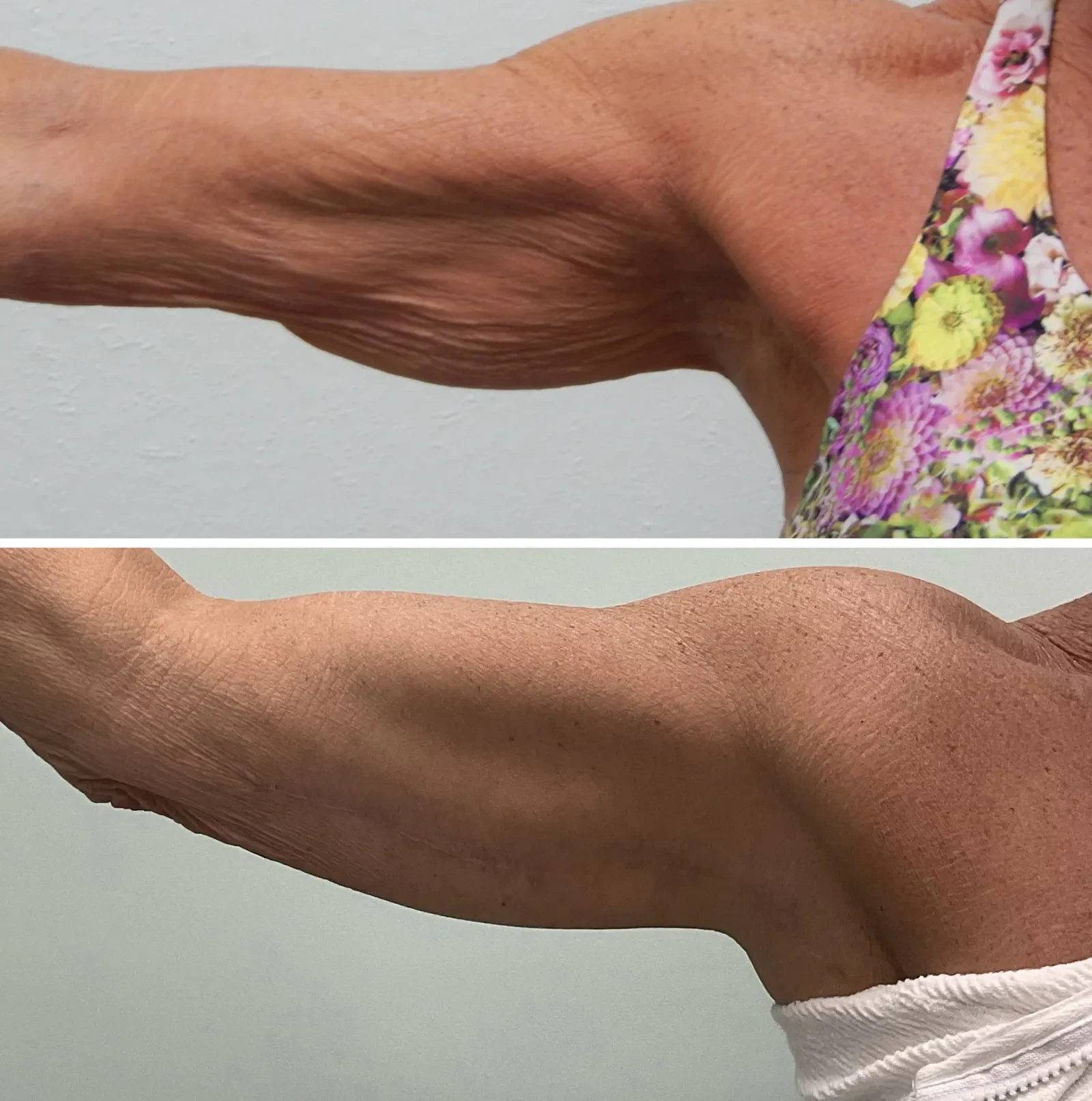 A result from Fort Lauderdale Plastic Surgery