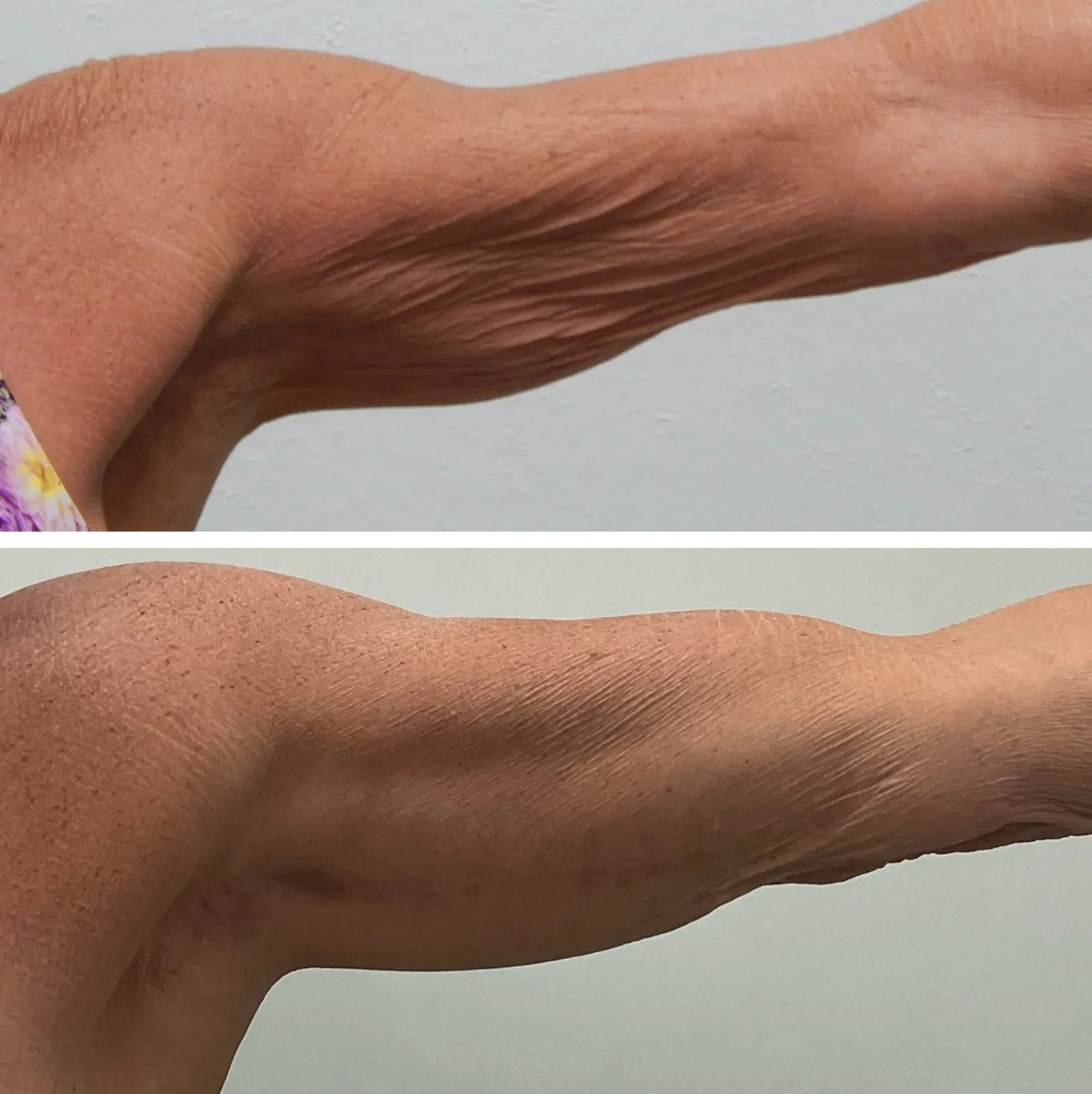 A result from Fort Lauderdale Plastic Surgery