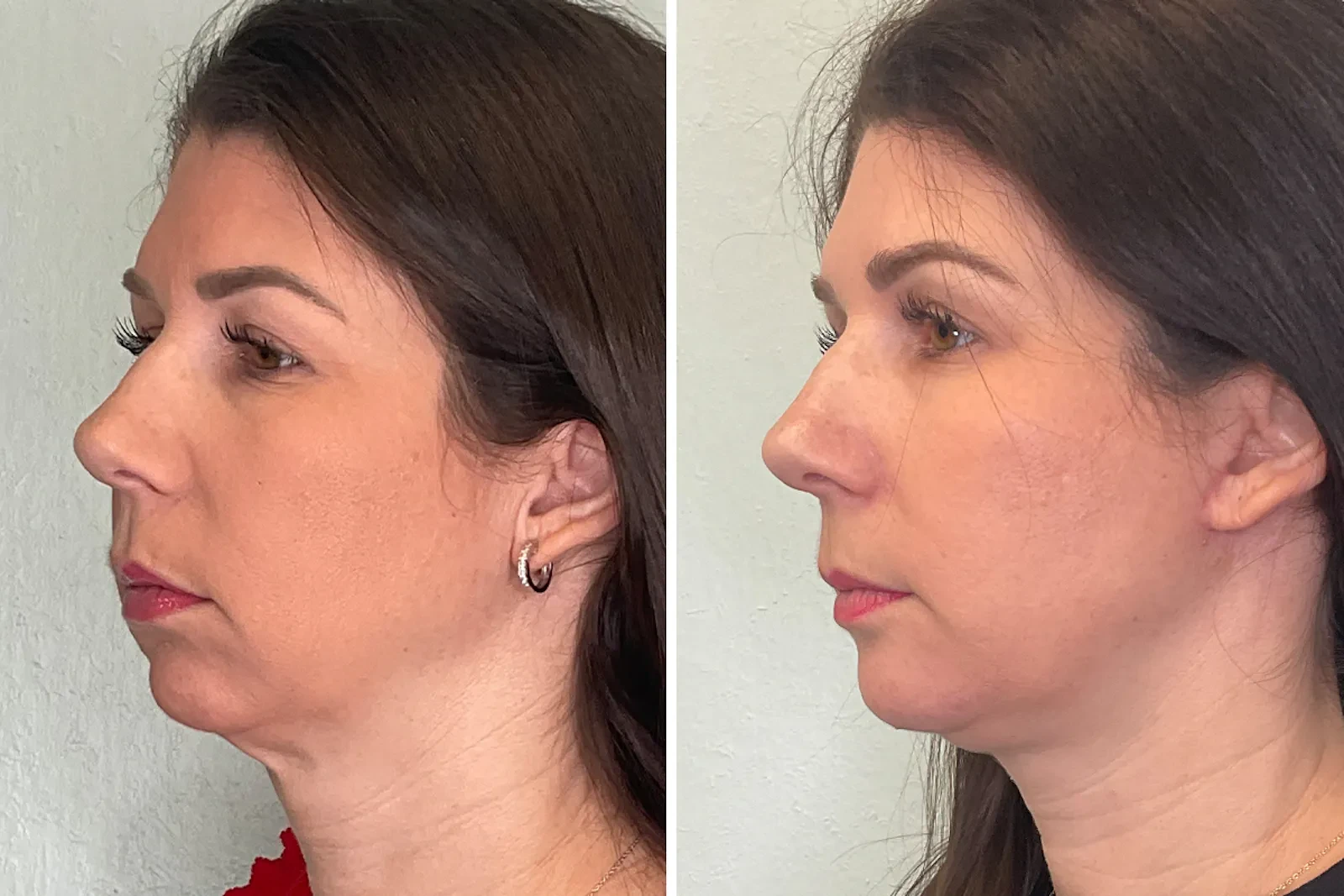 A result from Fort Lauderdale Plastic Surgery