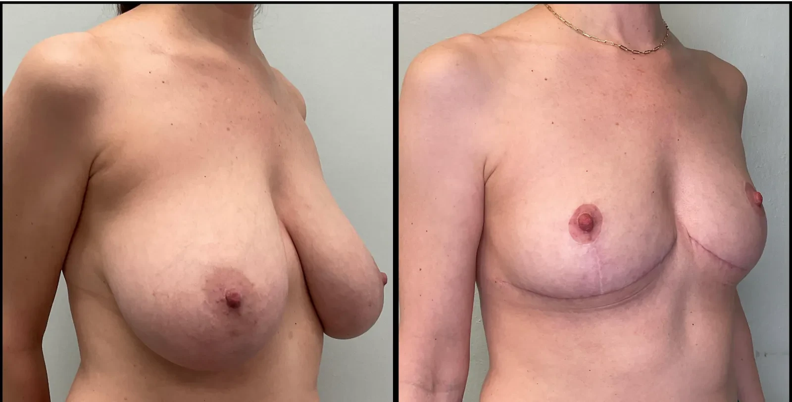 A result from Fort Lauderdale Plastic Surgery