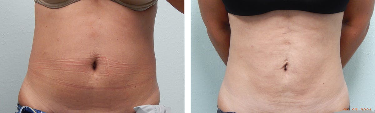 A result from Fort Lauderdale Plastic Surgery