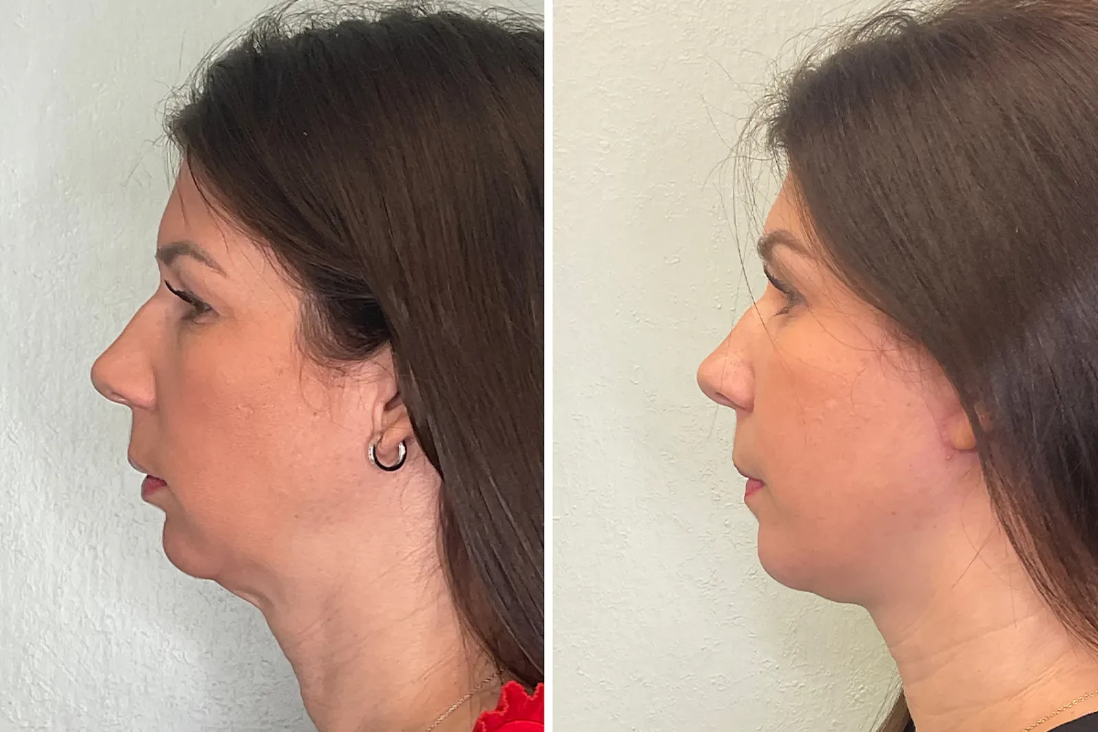 A result from Fort Lauderdale Plastic Surgery