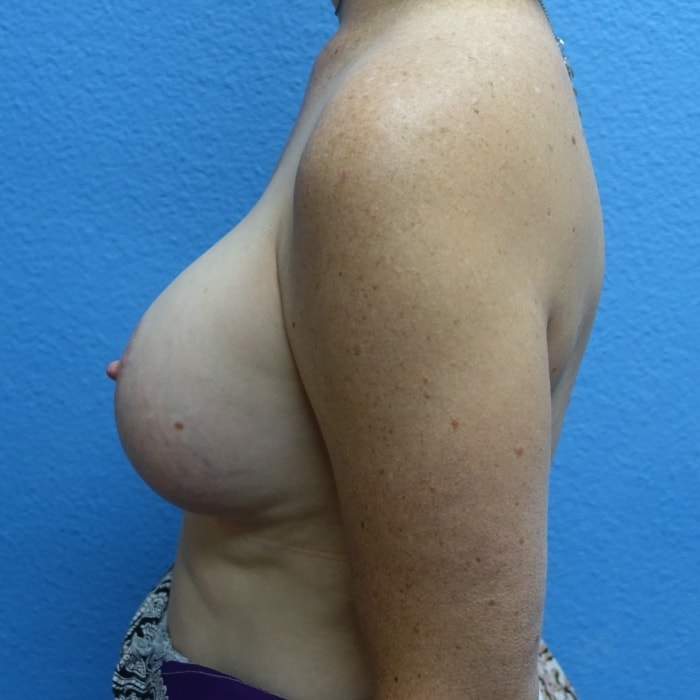 A result from Hankins & Sohn Plastic Surgery Associates