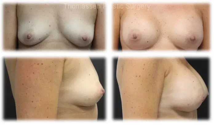 A result from Thomassen Plastic Surgery