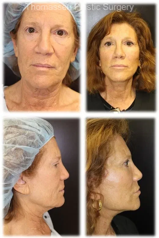 A result from Thomassen Plastic Surgery
