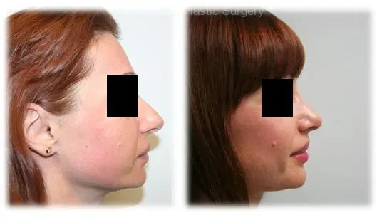 A result from Thomassen Plastic Surgery