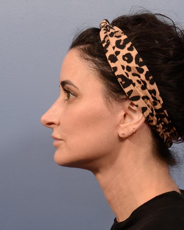 A result from Yirae Ort MD Facial Aesthetic Surgery