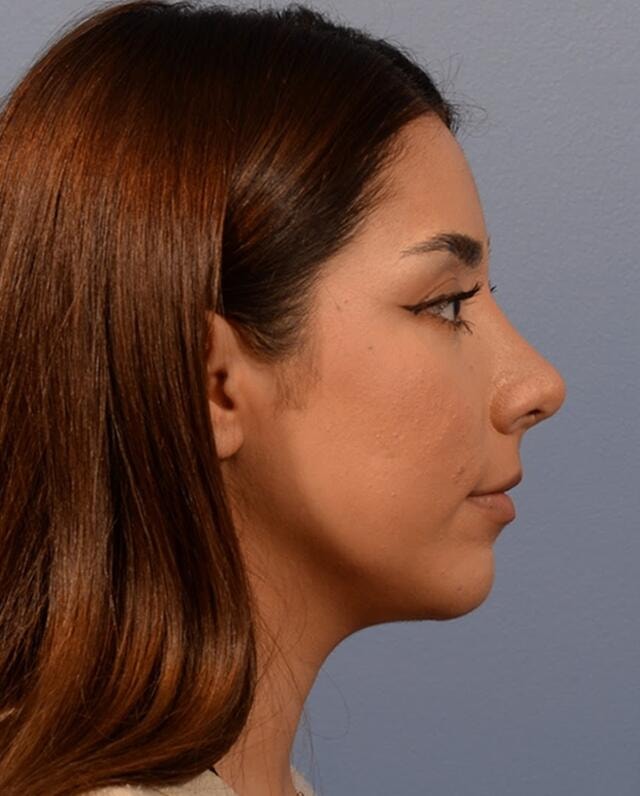 A result from Yirae Ort MD Facial Aesthetic Surgery