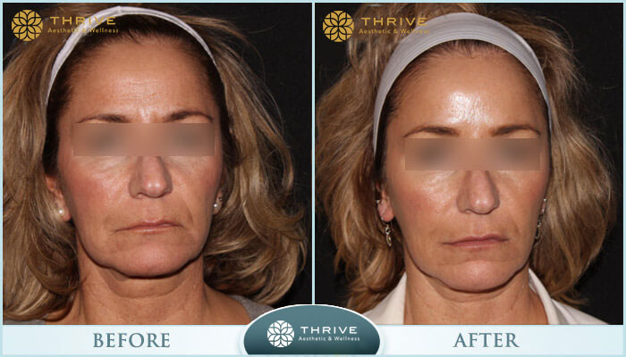 A result from Thrive Aesthetic & Wellness