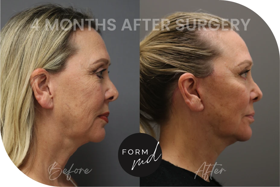 A result from FormMD Plastic Surgery - Dr. Pollei