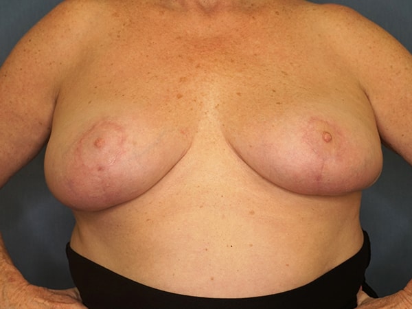 Breast Lift result at Herte Center for Cosmetic Surgery