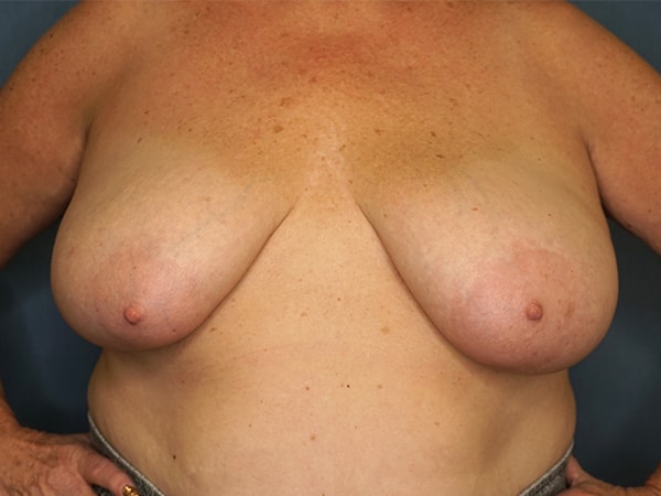 Breast Lift before photo