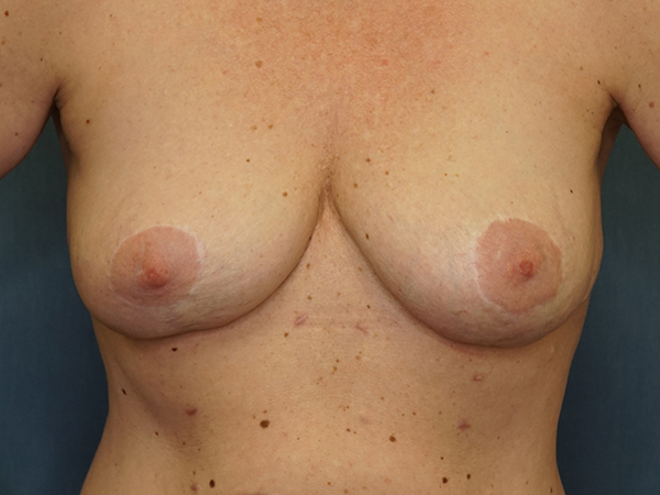 Implant Revision result at Herte Center for Cosmetic Surgery
