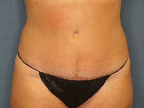 Tummy Tuck result at Herte Center for Cosmetic Surgery