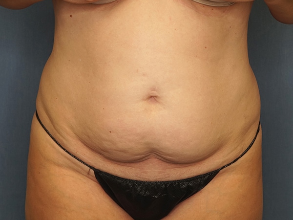 Tummy Tuck before photo