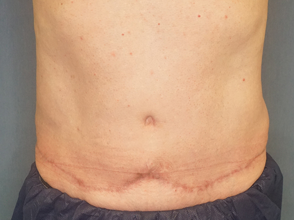 Tummy Tuck result at Herte Center for Cosmetic Surgery