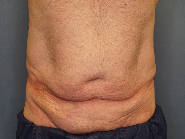 Tummy Tuck before photo