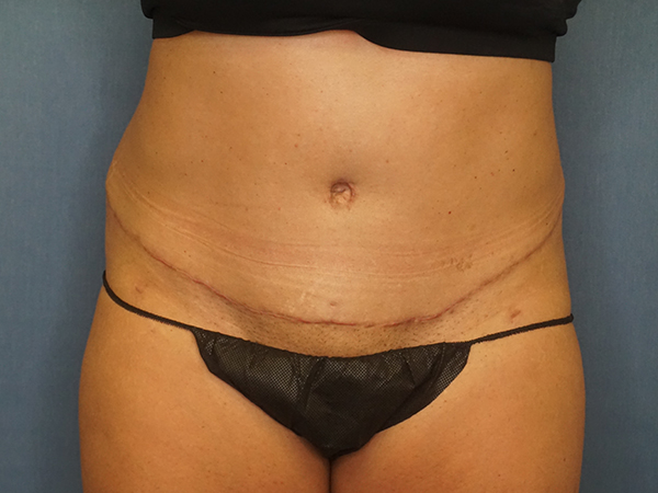 Herte Center for Cosmetic Surgery liposuction after — Las Vegas, NV