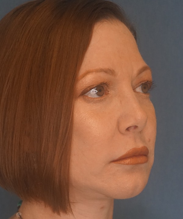 A result from Herte Center for Cosmetic Surgery