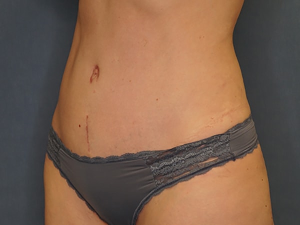 A result from Herte Center for Cosmetic Surgery