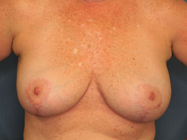 Implant Revision result at Herte Center for Cosmetic Surgery