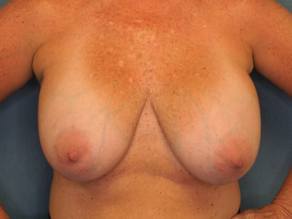Implant Revision before photo