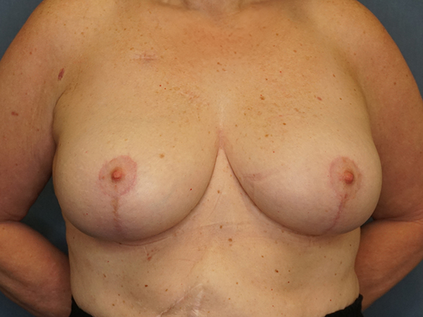 Breast Lift result at Herte Center for Cosmetic Surgery