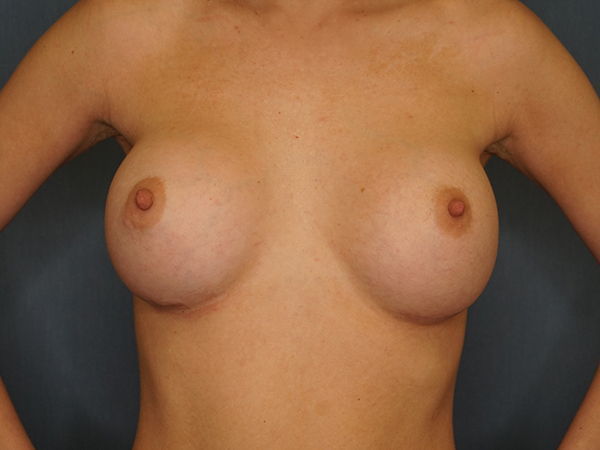 Breast Augmentation result at Herte Center for Cosmetic Surgery