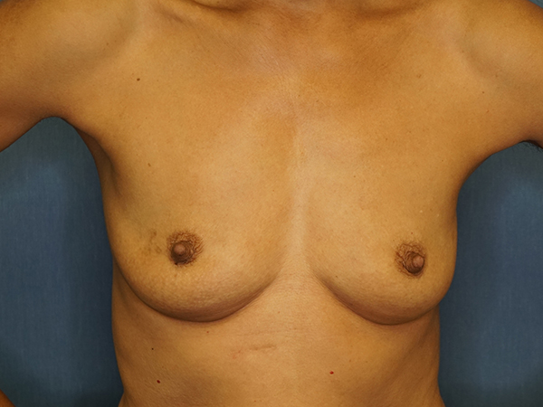 Breast Augmentation before photo