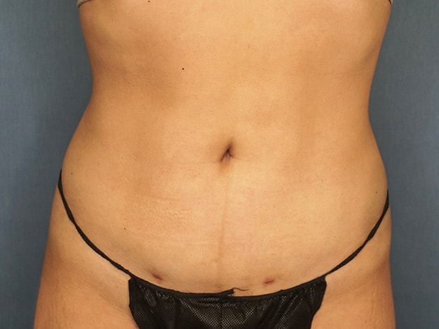 Herte Center for Cosmetic Surgery liposuction after — Las Vegas, NV
