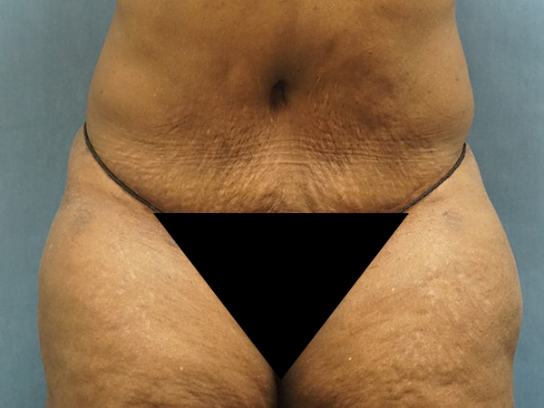 Tummy Tuck result at Herte Center for Cosmetic Surgery