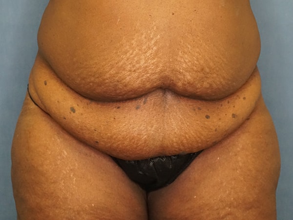 Tummy Tuck before photo