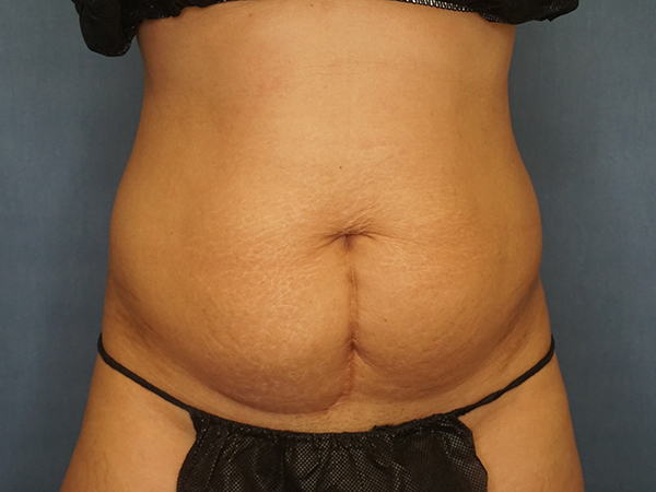 Tummy Tuck before photo