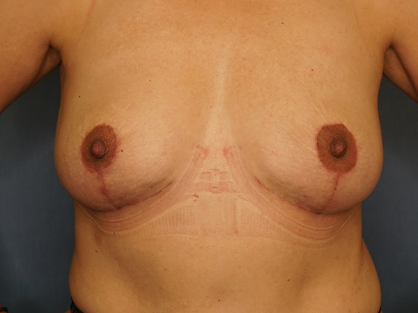 Implant Revision result at Herte Center for Cosmetic Surgery