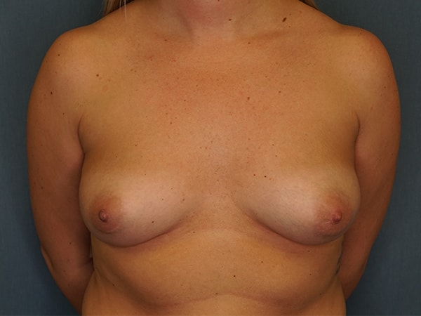 Breast Augmentation before photo