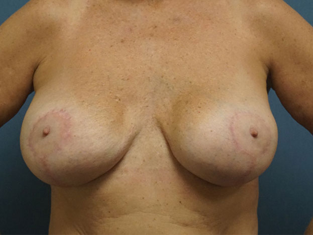Breast Lift result at Herte Center for Cosmetic Surgery