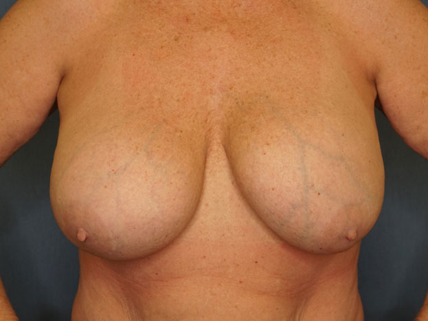 Breast Lift before photo