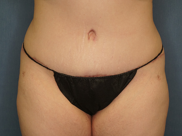 Tummy Tuck result at Herte Center for Cosmetic Surgery
