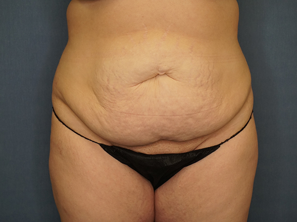 Tummy Tuck before photo