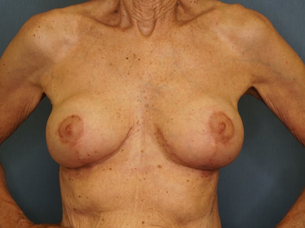 Breast Lift result at Herte Center for Cosmetic Surgery