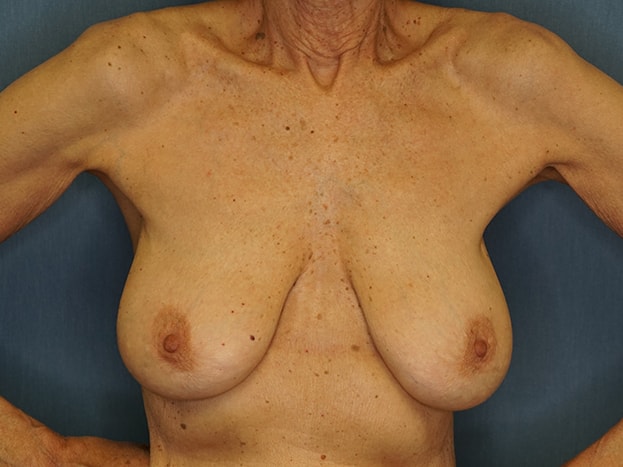 Breast Lift before photo