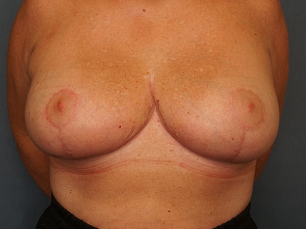 Herte Center for Cosmetic Surgery breast reduction after — Las Vegas, NV