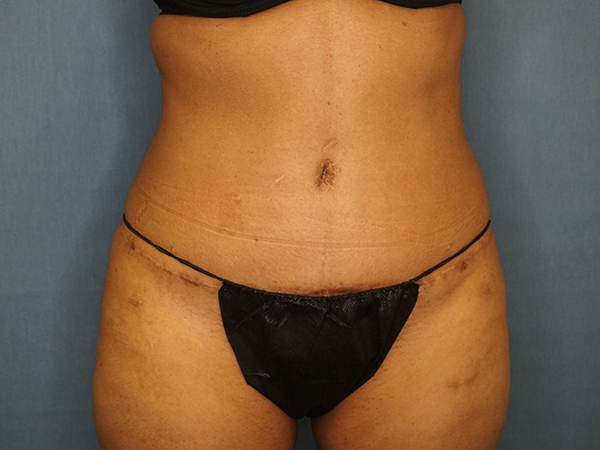 Tummy Tuck result at Herte Center for Cosmetic Surgery