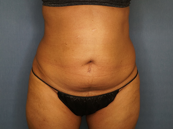 Tummy Tuck before photo
