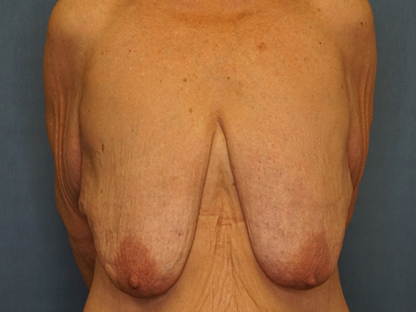 Breast Lift before photo
