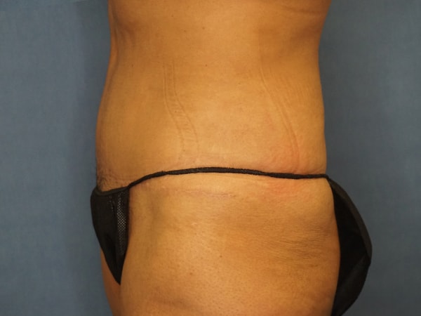 A result from Herte Center for Cosmetic Surgery