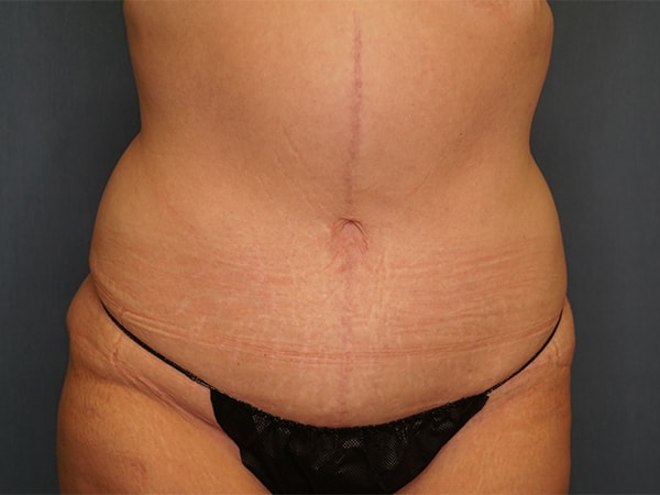 Herte Center for Cosmetic Surgery liposuction after — Las Vegas, NV