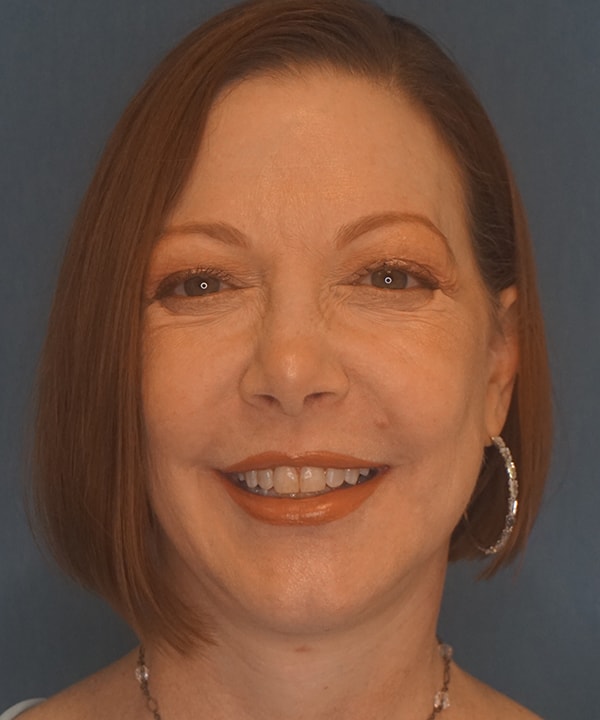 A result from Herte Center for Cosmetic Surgery