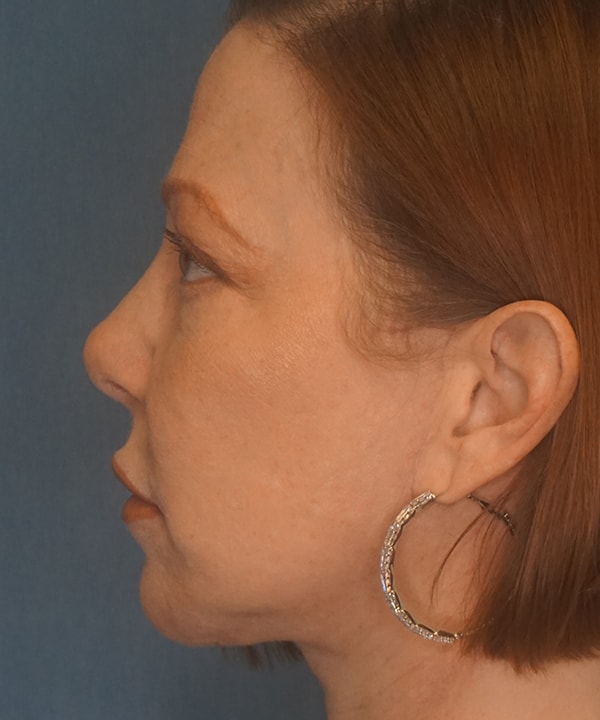 A result from Herte Center for Cosmetic Surgery