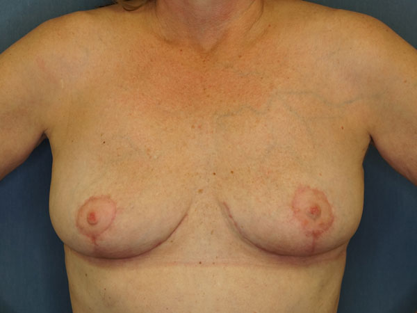 Implant Revision result at Herte Center for Cosmetic Surgery